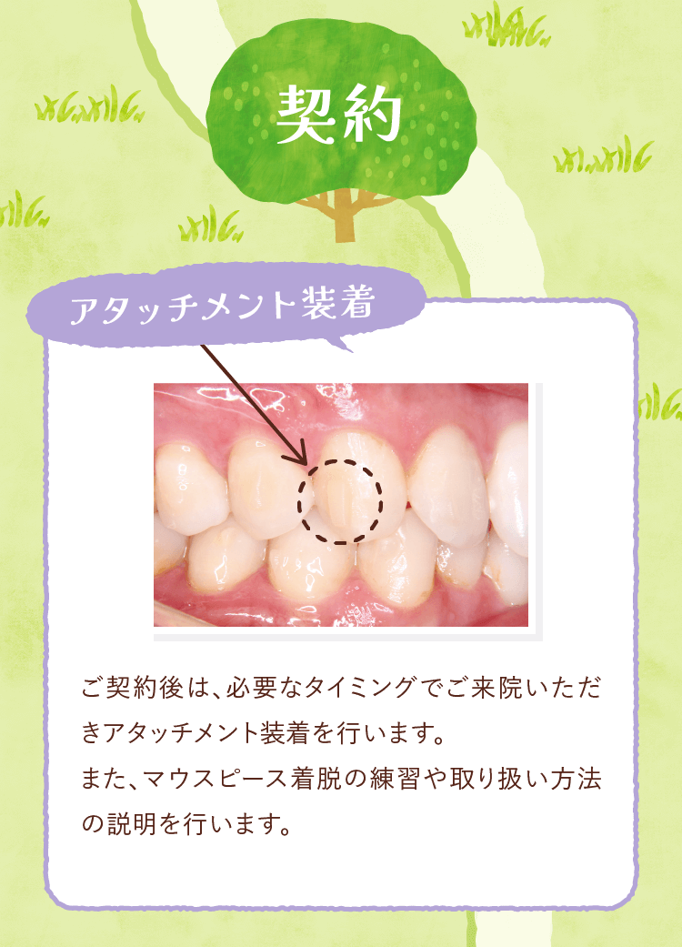 契約・アタッチメント装着